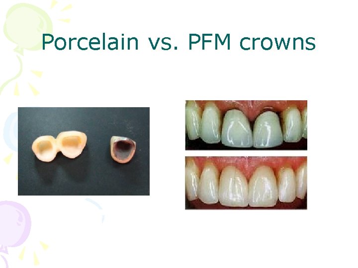 Porcelain vs. PFM crowns 