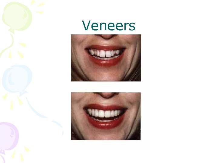 Veneers 