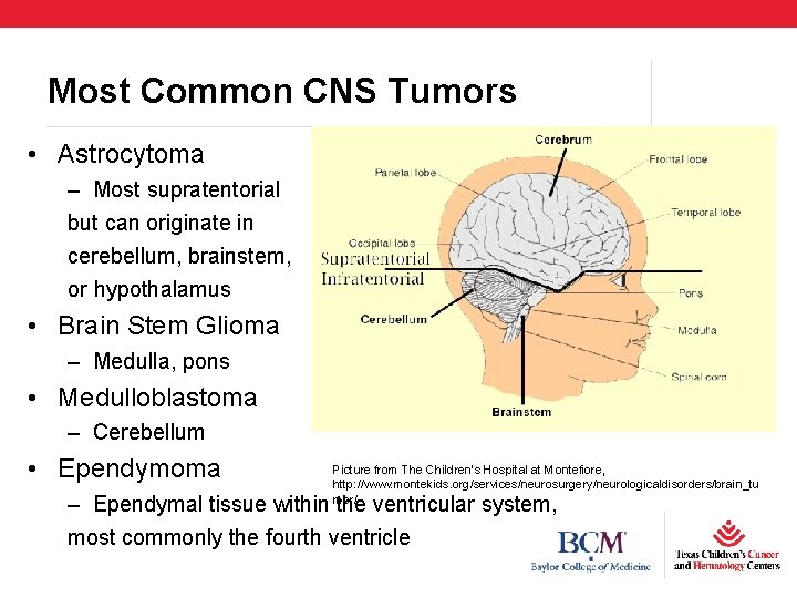 Most Common CNS Tumors • Astrocytoma – Most supratentorial but can originate in cerebellum,