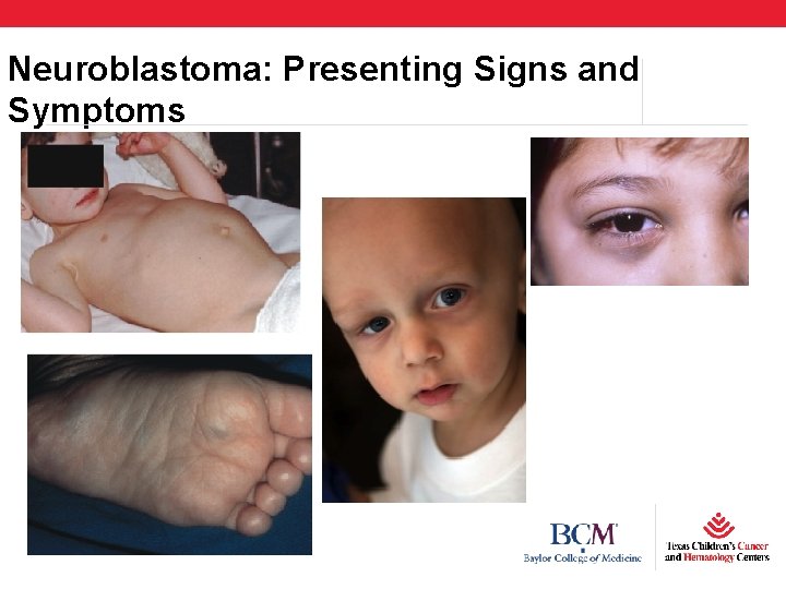 Neuroblastoma: Presenting Signs and Symptoms 