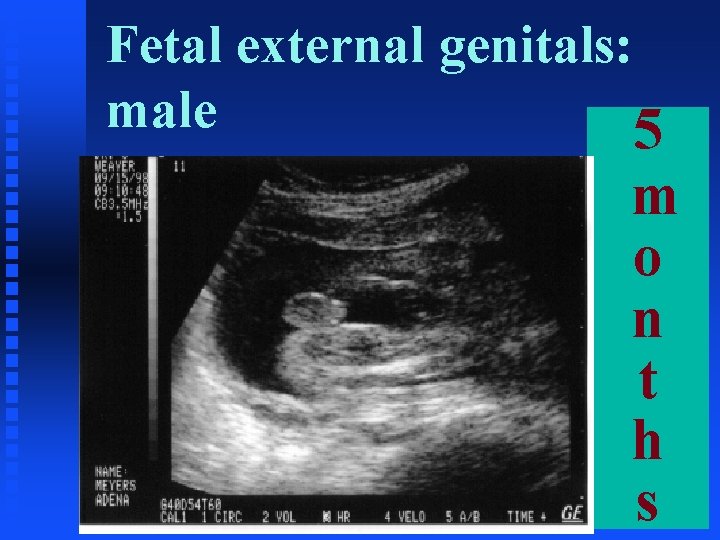 Fetal external genitals: male 5 m o n t h s 