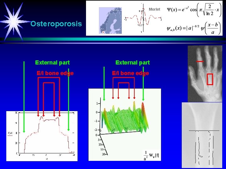 Morlet Osteroporosis External part E/I bone edge 