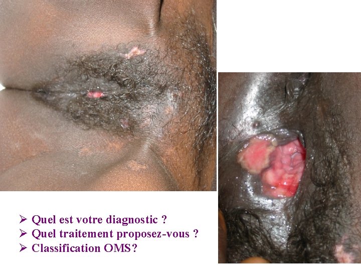 Ø Quel est votre diagnostic ? Ø Quel traitement proposez-vous ? Ø Classification OMS? Ø Quel est votre diagnostic ? Ø Quel traitement proposez-vous ? Ø Classification OMS?