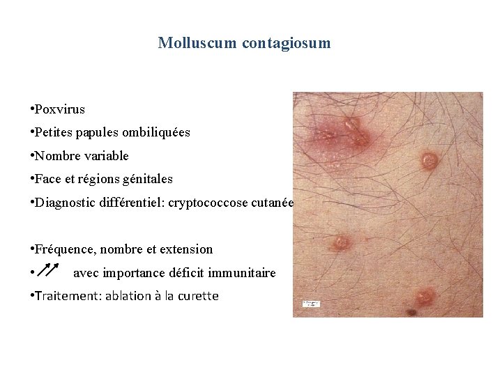 Molluscum contagiosum • Poxvirus • Petites papules ombiliquées • Nombre variable • Face et Molluscum contagiosum • Poxvirus • Petites papules ombiliquées • Nombre variable • Face et
