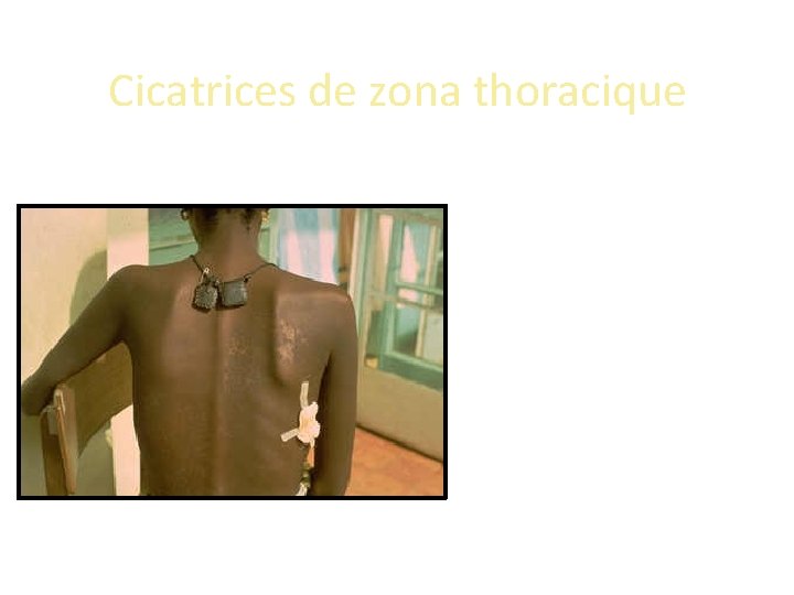 Cicatrices de zona thoracique Cicatrices de zona thoracique