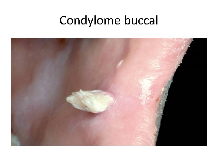 Condylome buccal Condylome buccal