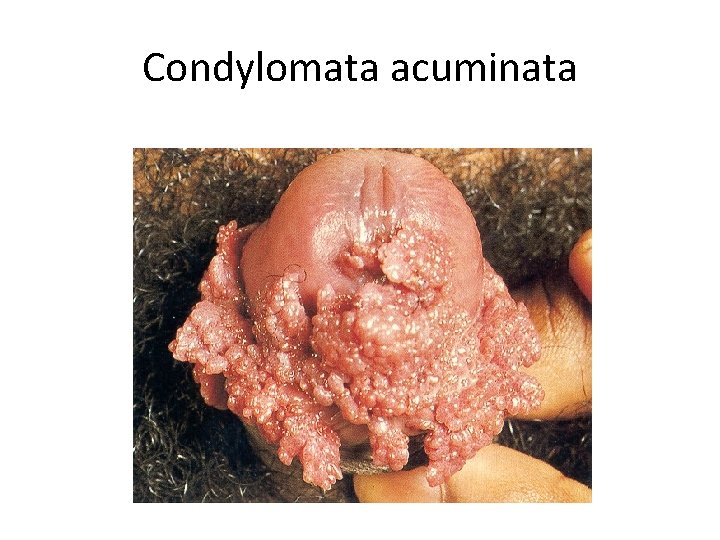 Condylomata acuminata Condylomata acuminata