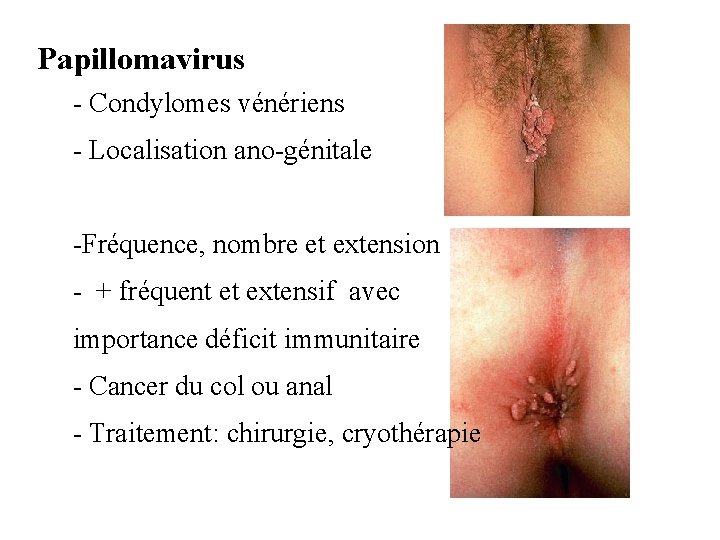 Papillomavirus - Condylomes vénériens - Localisation ano-génitale -Fréquence, nombre et extension - + fréquent Papillomavirus - Condylomes vénériens - Localisation ano-génitale -Fréquence, nombre et extension - + fréquent