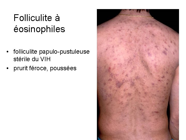 Folliculite à éosinophiles • folliculite papulo-pustuleuse stérile du VIH • prurit féroce, poussées Folliculite à éosinophiles • folliculite papulo-pustuleuse stérile du VIH • prurit féroce, poussées