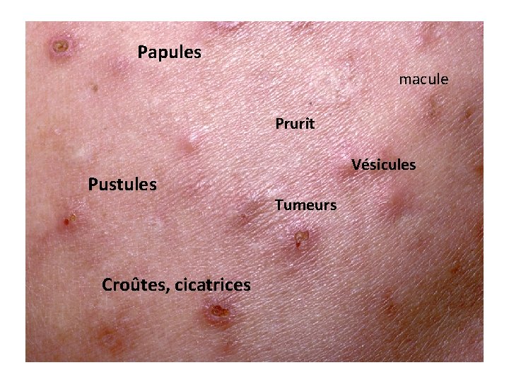 Papules macule Prurit Pustules Croûtes, cicatrices Vésicules Tumeurs Papules macule Prurit Pustules Croûtes, cicatrices Vésicules Tumeurs