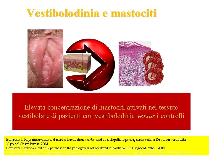 Vestibolodinia e mastociti Elevata concentrazione di mastociti attivati nel tessuto vestibolare di pazienti con