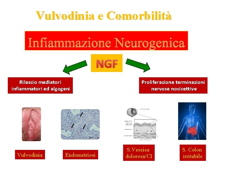 Vulvodinia e Comorbilità Infiammazione Neurogenica NGF Rilascio mediatori infiammatori ed algogeni Vulvodinia Endometriosi Proliferazione