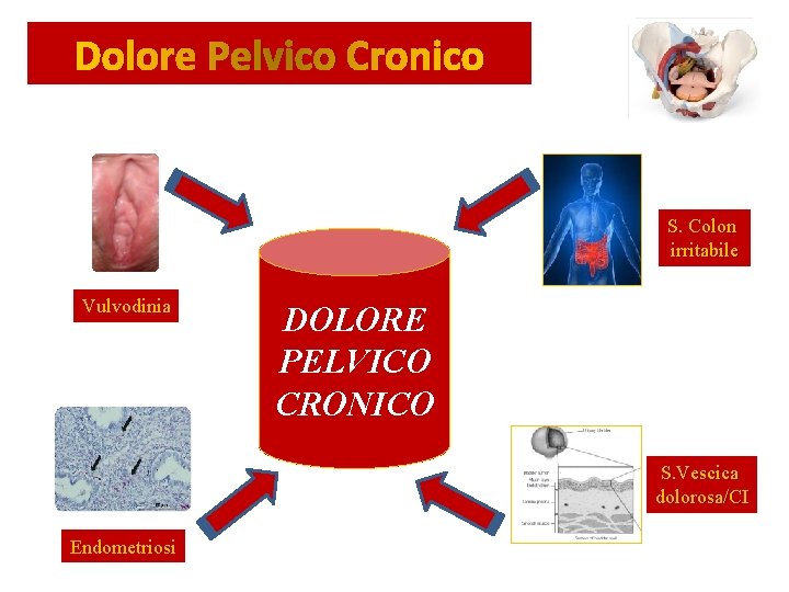 Dolore Pelvico Cronico S. Colon irritabile Vulvodinia DOLORE PELVICO CRONICO S. Vescica dolorosa/CI Endometriosi