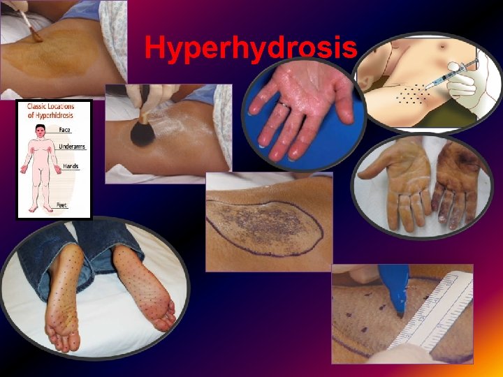 Hyperhydrosis 