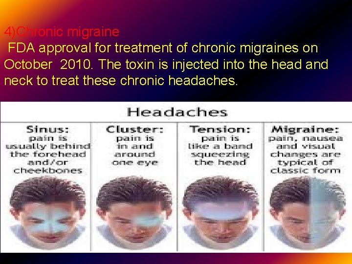 4)Chronic migraine FDA approval for treatment of chronic migraines on October 2010. The toxin