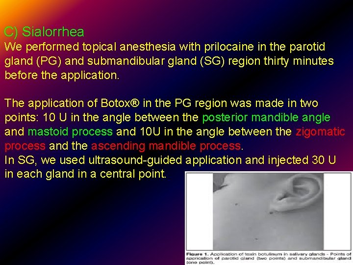 C) Sialorrhea We performed topical anesthesia with prilocaine in the parotid gland (PG) and