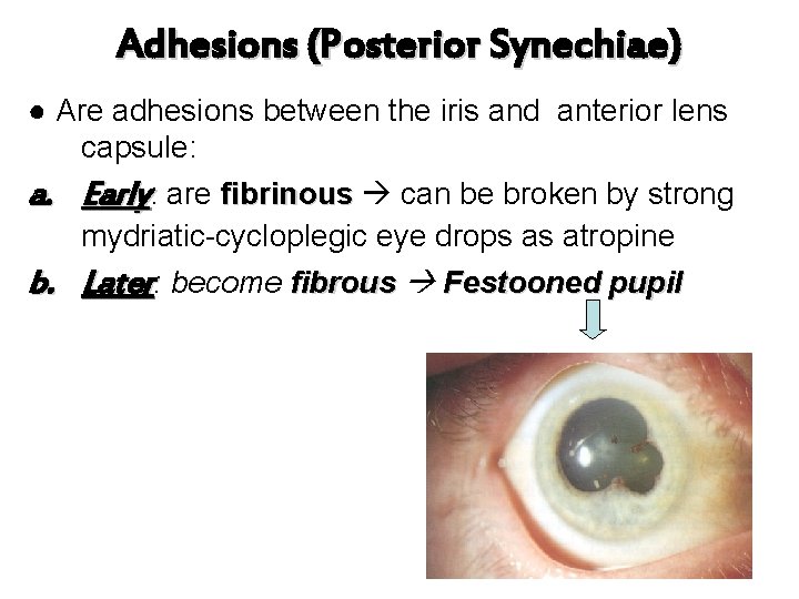 Adhesions (Posterior Synechiae) ● Are adhesions between the iris and anterior lens capsule: a.