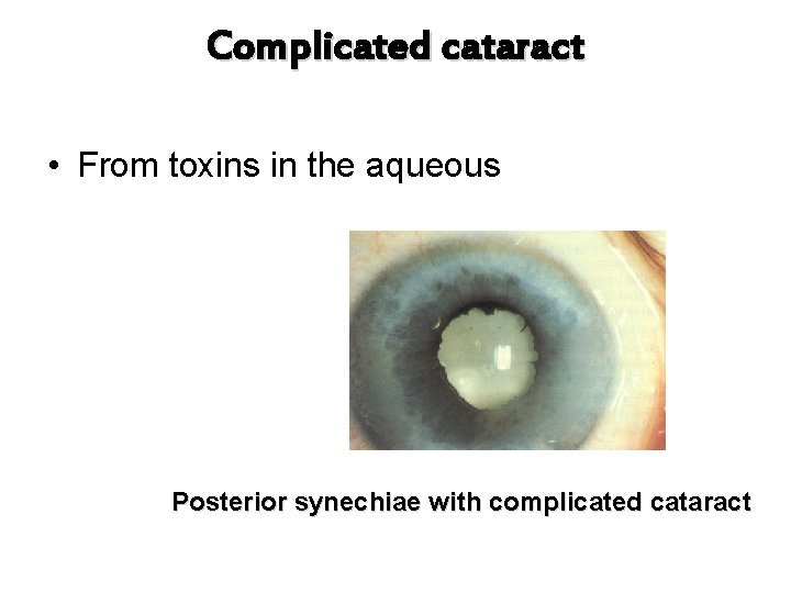 Complicated cataract • From toxins in the aqueous Posterior synechiae with complicated cataract 