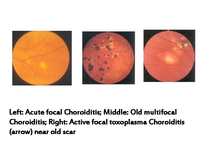 Left: Acute focal Choroiditis; Middle: Old multifocal Choroiditis; Right: Active focal toxoplasma Choroiditis (arrow)