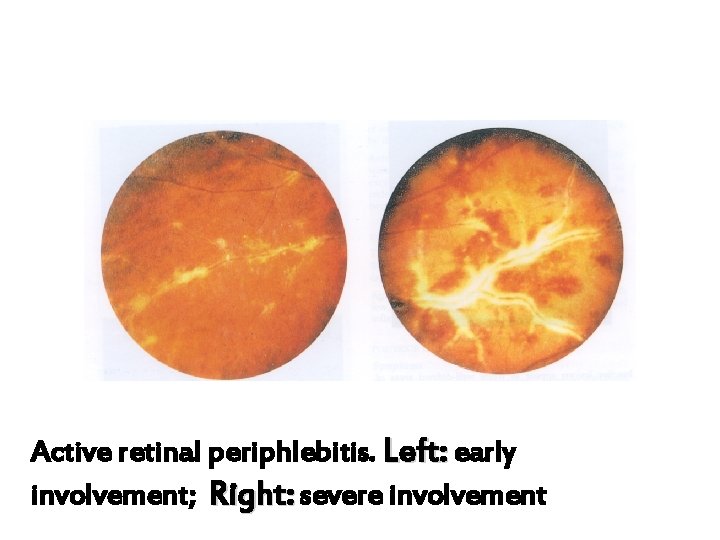 Active retinal periphlebitis. Left: early involvement; Right: severe involvement 