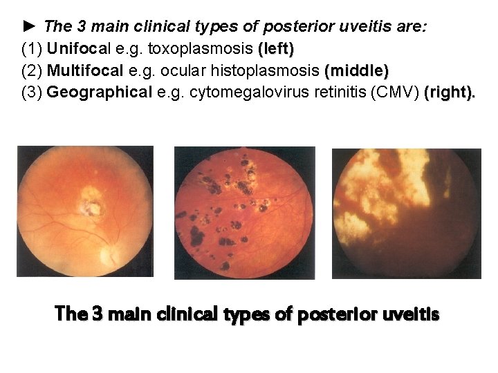 ► The 3 main clinical types of posterior uveitis are: (1) Unifocal e. g.