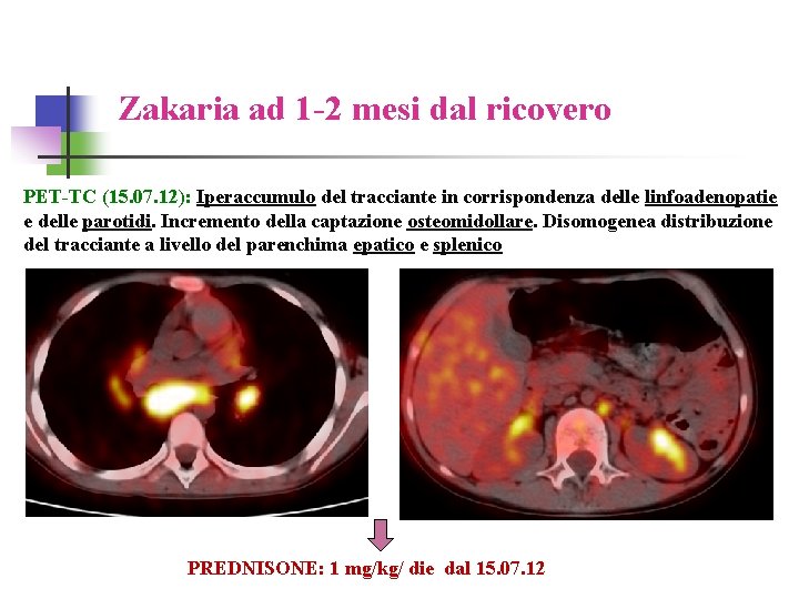 Zakaria ad 1 -2 mesi dal ricovero PET-TC (15. 07. 12): Iperaccumulo del tracciante