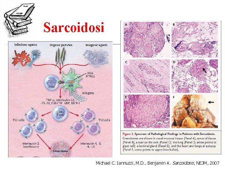 Sarcoidosi Michael C. Iannuzzi, M. D. , Benjamin A. Sarcoidosis, NEJM, 2007 