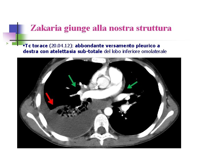 Zakaria giunge alla nostra struttura Ø §Tc torace (20. 04. 12): abbondante versamento pleurico