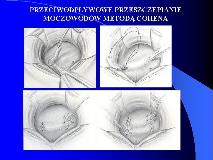 PRZECIWODPŁYWOWE PRZESZCZEPIANIE MOCZOWODÓW METODĄ COHENA 