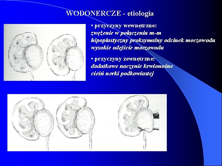 WODONERCZE - etiologia • przyczyny wewnętrzne: zwężenie w połączeniu m-m hipoplastyczny proksymalny odcinek moczowodu WODONERCZE - etiologia • przyczyny wewnętrzne: zwężenie w połączeniu m-m hipoplastyczny proksymalny odcinek moczowodu