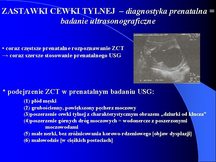 ZASTAWKI CEWKI TYLNEJ – diagnostyka prenatalna = badanie ultrasonograficzne • coraz częstsze prenatalne rozpoznawanie ZASTAWKI CEWKI TYLNEJ – diagnostyka prenatalna = badanie ultrasonograficzne • coraz częstsze prenatalne rozpoznawanie