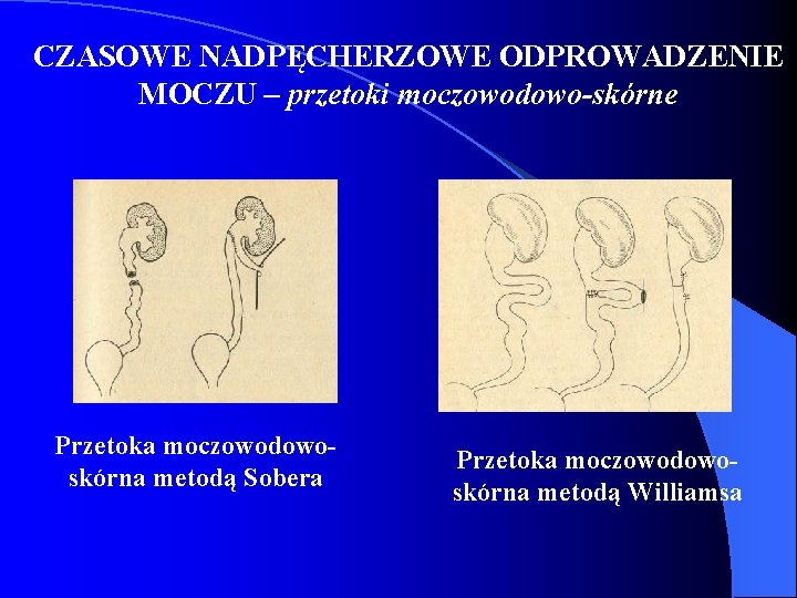 CZASOWE NADPĘCHERZOWE ODPROWADZENIE MOCZU – przetoki moczowodowo-skórne Przetoka moczowodowoskórna metodą Sobera Przetoka moczowodowoskórna metodą