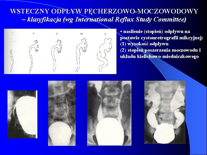 WSTECZNY ODPŁYW PĘCHERZOWO-MOCZOWODOWY – klasyfikacja (wg International Reflux Study Committee) • nasilenie (stopień) odpływu WSTECZNY ODPŁYW PĘCHERZOWO-MOCZOWODOWY – klasyfikacja (wg International Reflux Study Committee) • nasilenie (stopień) odpływu
