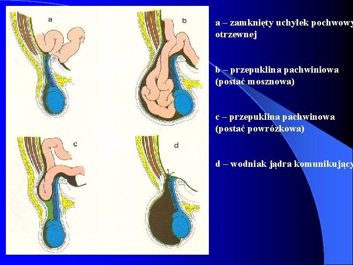 a – zamknięty uchyłek pochwowy otrzewnej b – przepuklina pachwiniowa (postać mosznowa) c –