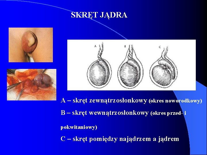 SKRĘT JĄDRA A – skręt zewnątrzosłonkowy (okres noworodkowy) B – skręt wewnątrzosłonkowy (okres przed-