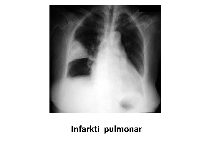 Infarkti pulmonar Infarkti pulmonar