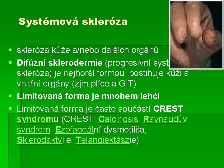 Systémová skleróza § skleróza kůže a/nebo dalších orgánů § Difúzní sklerodermie (progresivní systémová skleróza)