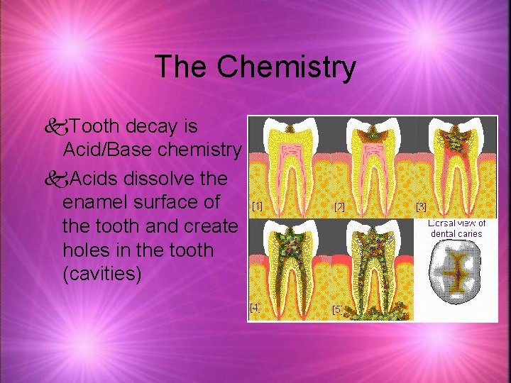 The Chemistry k. Tooth decay is Acid/Base chemistry k. Acids dissolve the enamel surface