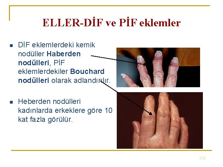 ELLER-DİF ve PİF eklemler n DİF eklemlerdeki kemik nodüller Haberden nodülleri, PİF eklemlerdekiler Bouchard ELLER-DİF ve PİF eklemler n DİF eklemlerdeki kemik nodüller Haberden nodülleri, PİF eklemlerdekiler Bouchard