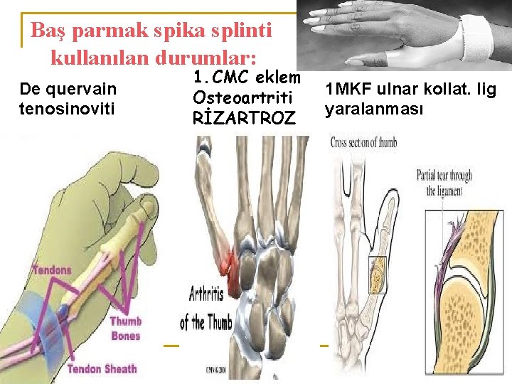 Baş parmak spika splinti kullanılan durumlar: De quervain tenosinoviti 1. CMC eklem Osteoartriti RİZARTROZ Baş parmak spika splinti kullanılan durumlar: De quervain tenosinoviti 1. CMC eklem Osteoartriti RİZARTROZ
