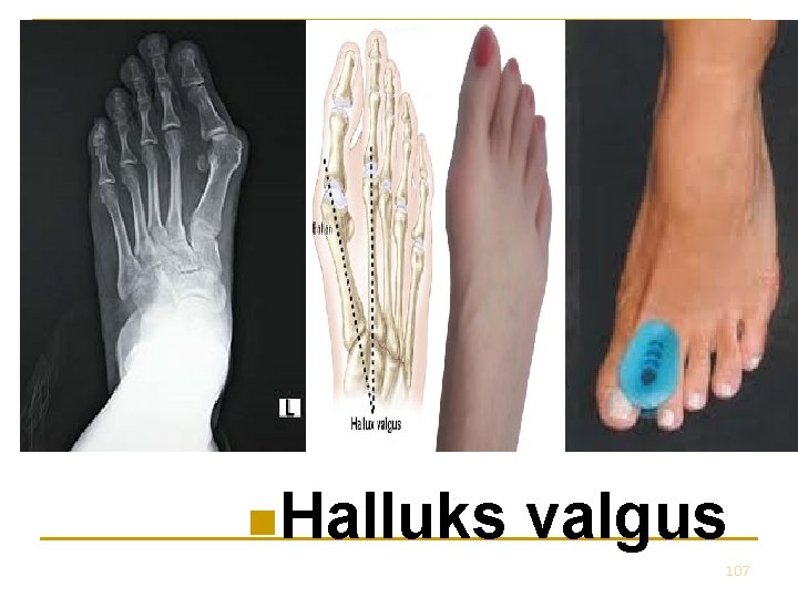 n. Halluks valgus 107 n. Halluks valgus 107