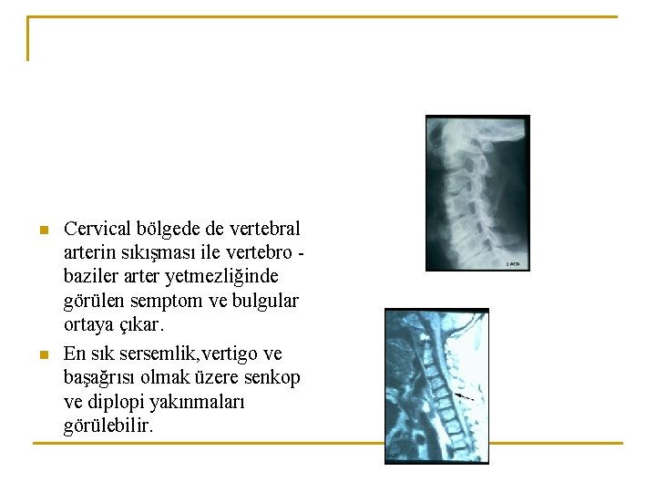 n n Cervical bölgede de vertebral arterin sıkışması ile vertebro baziler arter yetmezliğinde görülen n n Cervical bölgede de vertebral arterin sıkışması ile vertebro baziler arter yetmezliğinde görülen