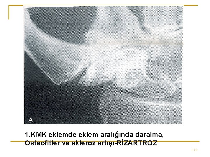 1. KMK eklemde eklem aralığında daralma, Osteofitler ve skleroz artışı-RİZARTROZ 114 1. KMK eklemde eklem aralığında daralma, Osteofitler ve skleroz artışı-RİZARTROZ 114