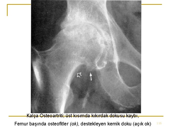 Kalça Osteoartriti; üst kısımda kıkırdak dokusu kaybı, Femur başında osteofitler (ok), destekleyen kemik doku Kalça Osteoartriti; üst kısımda kıkırdak dokusu kaybı, Femur başında osteofitler (ok), destekleyen kemik doku