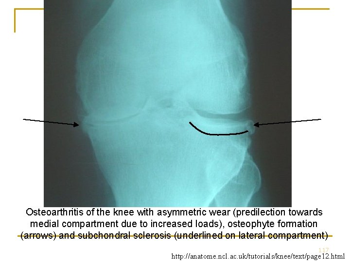 Osteoarthritis of the knee with asymmetric wear (predilection towards medial compartment due to increased Osteoarthritis of the knee with asymmetric wear (predilection towards medial compartment due to increased