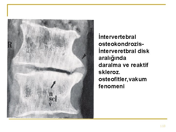 İntervertebral osteokondrozisİnterveretbral disk aralığında daralma ve reaktif skleroz. osteofitler, vakum fenomeni 118 İntervertebral osteokondrozisİnterveretbral disk aralığında daralma ve reaktif skleroz. osteofitler, vakum fenomeni 118