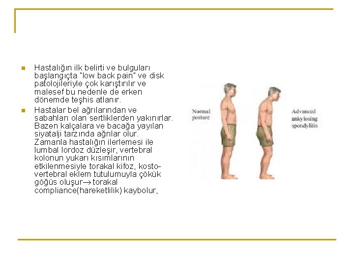 n n Hastalığın ilk belirti ve bulguları başlangıçta “low back pain” ve disk patolojileriyle n n Hastalığın ilk belirti ve bulguları başlangıçta “low back pain” ve disk patolojileriyle