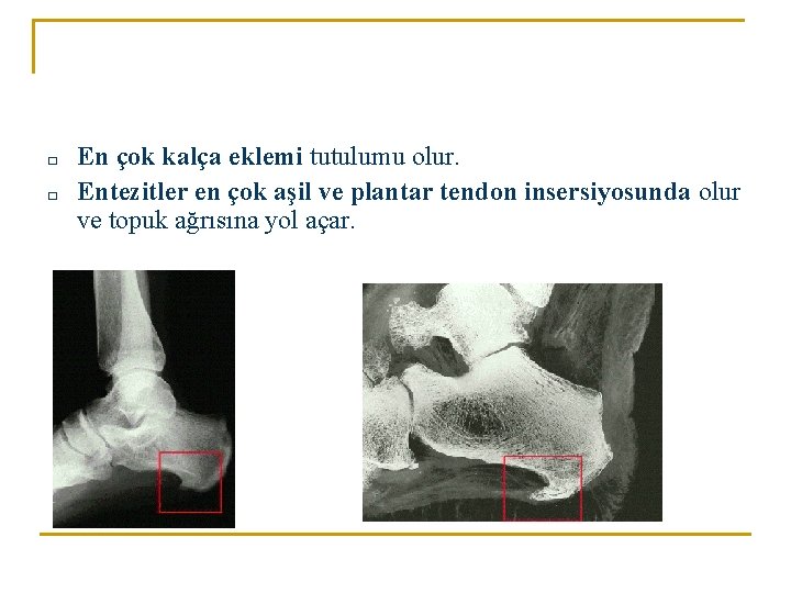 □ □ En çok kalça eklemi tutulumu olur. Entezitler en çok aşil ve plantar □ □ En çok kalça eklemi tutulumu olur. Entezitler en çok aşil ve plantar