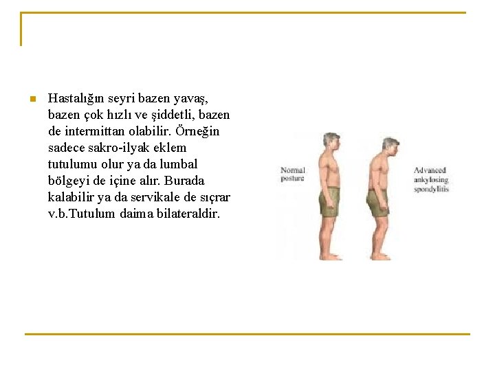 n Hastalığın seyri bazen yavaş, bazen çok hızlı ve şiddetli, bazen de intermittan olabilir. n Hastalığın seyri bazen yavaş, bazen çok hızlı ve şiddetli, bazen de intermittan olabilir.