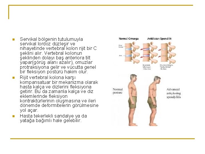 n n n Servikal bölgenin tutulumuyla servikal lordoz düzleşir ve nihayetinde vertebral kolon rijit n n n Servikal bölgenin tutulumuyla servikal lordoz düzleşir ve nihayetinde vertebral kolon rijit